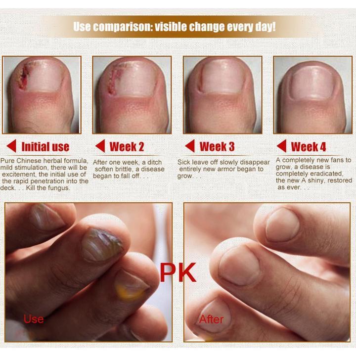 Nail Fungus Treatment